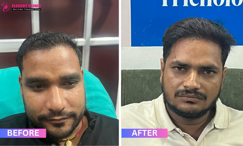 best hair transplant result in patna